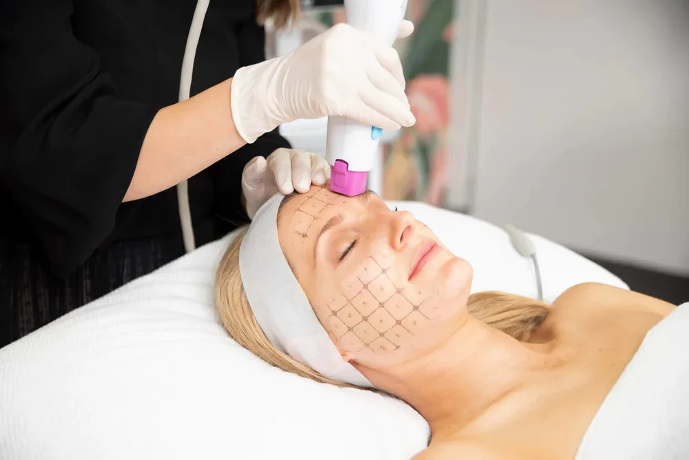 Công nghệ Thermage FLX là gì? Hiệu quả trẻ hóa và Cách chăm sóc da chuẩn y khoa